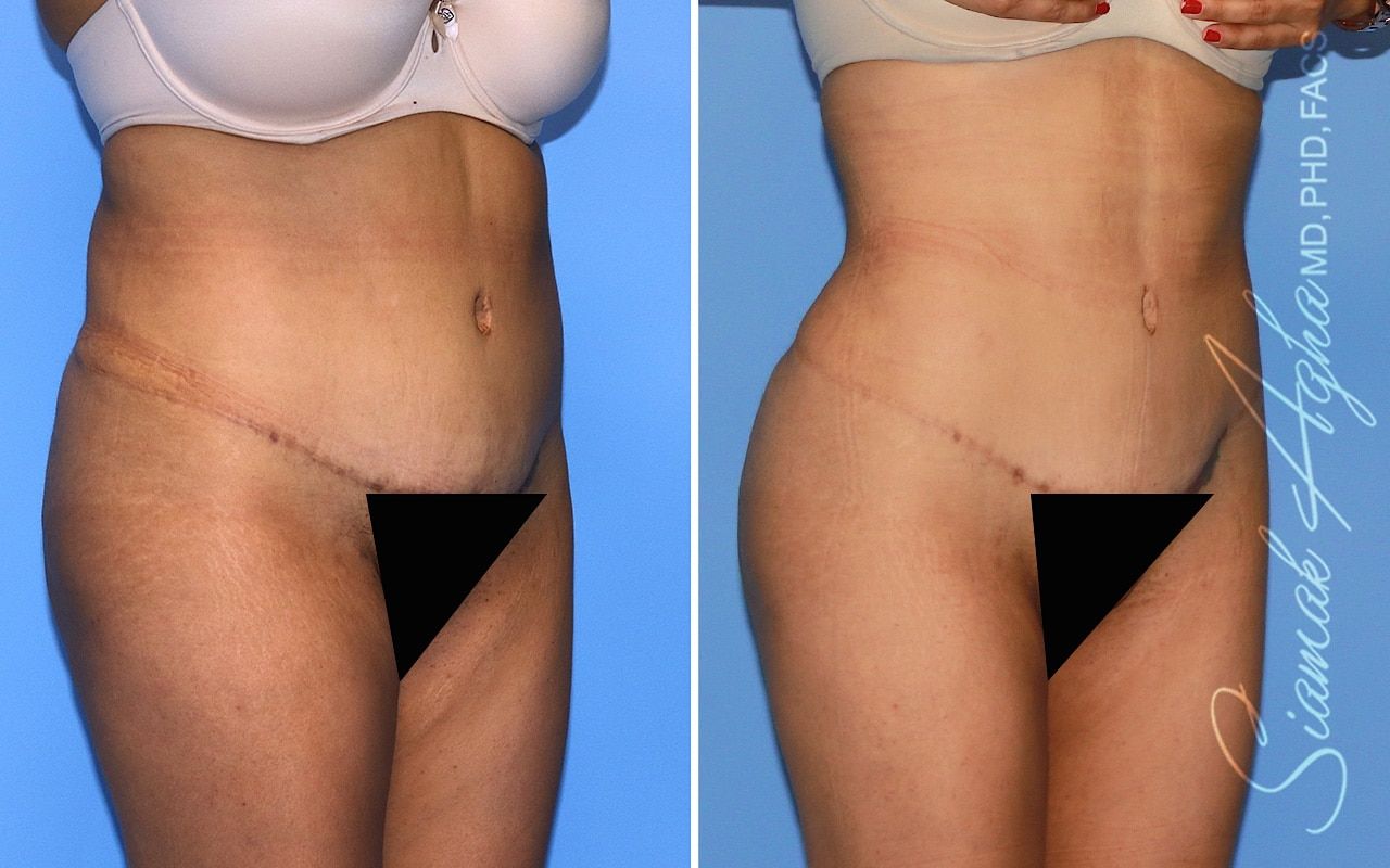 Brazilian Butt Lift Before & After