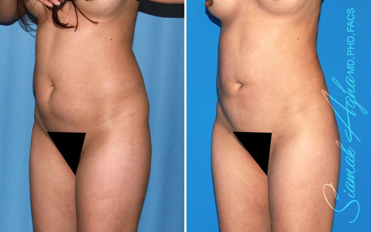 Brazilian Butt Lift Before & After