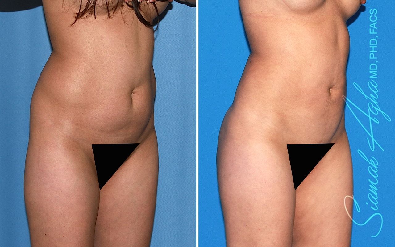 Brazilian Butt Lift Before & After