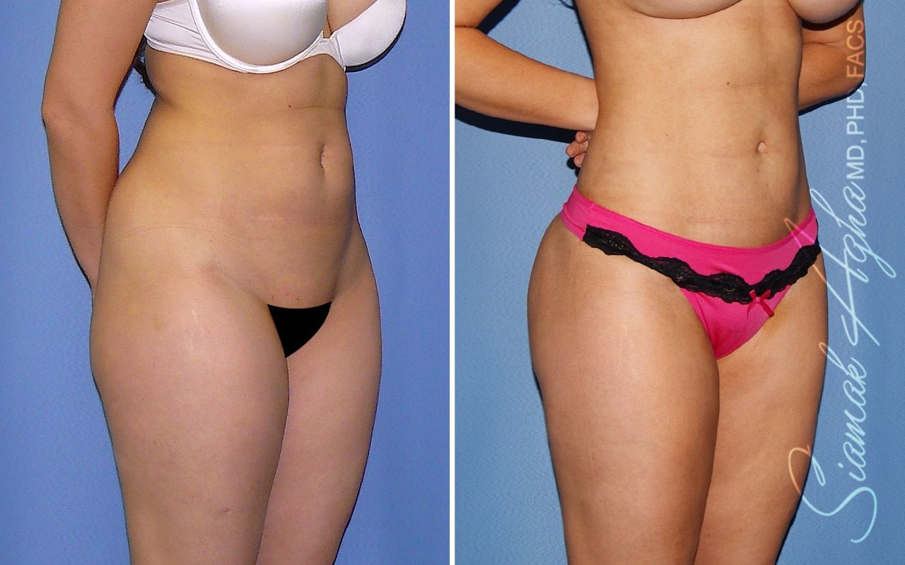 Brazilian Butt Lift Before & After