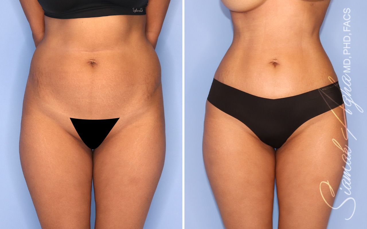 Brazilian Butt Lift Before & After