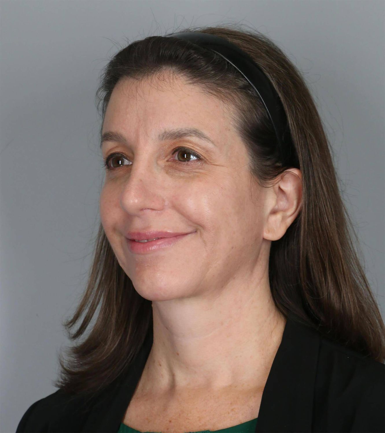 Restylane Before & After