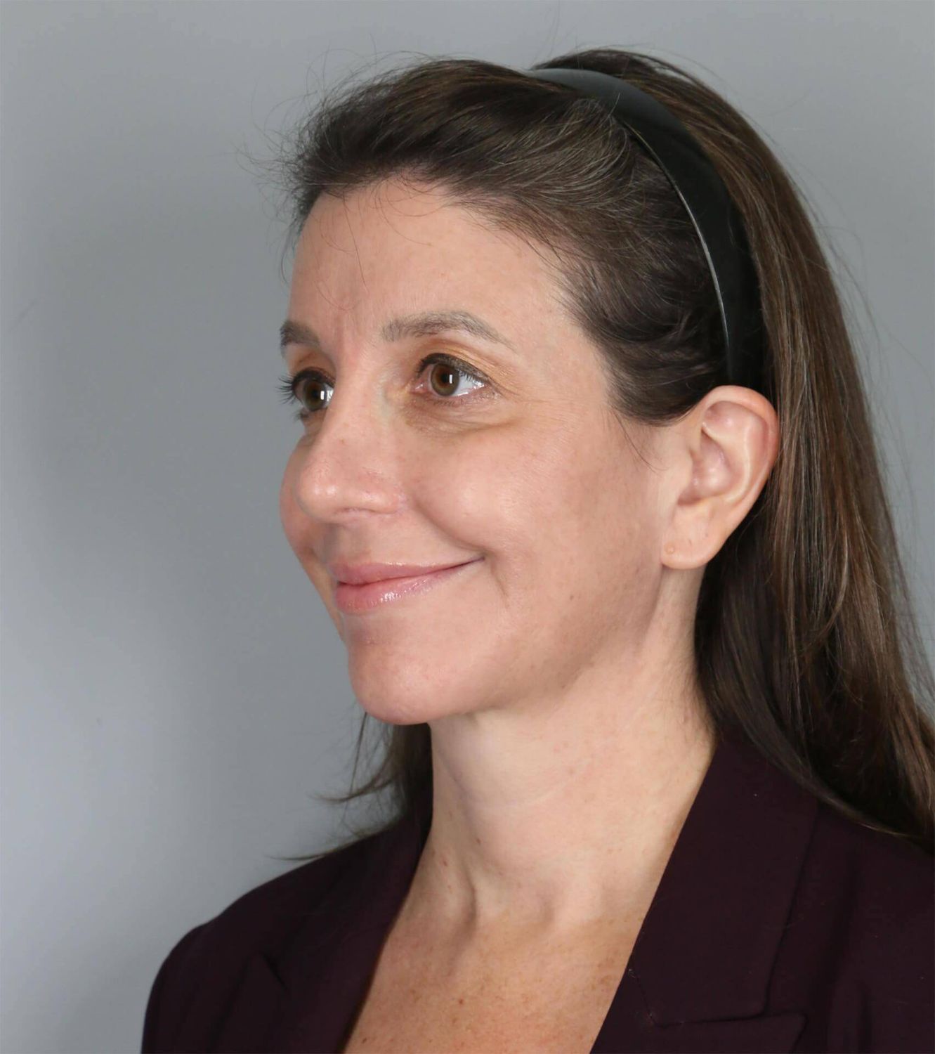 Restylane Before & After