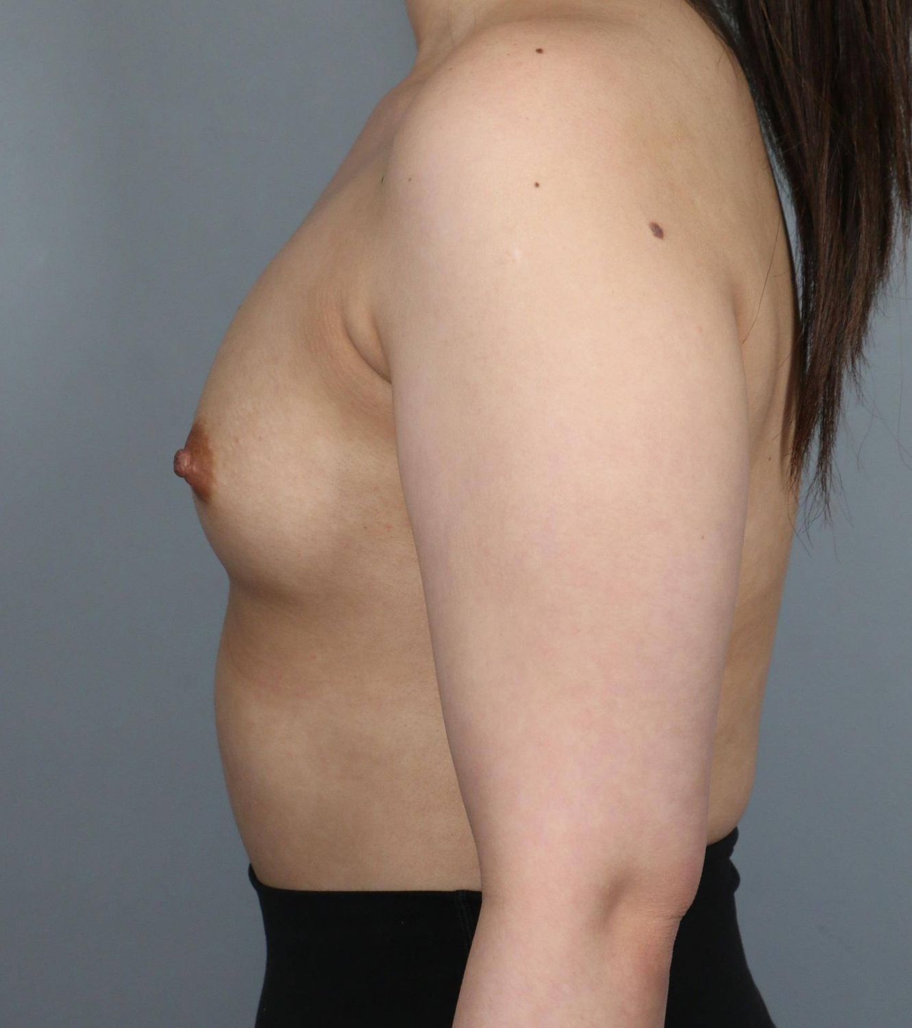 Breast Augmentation Before & After