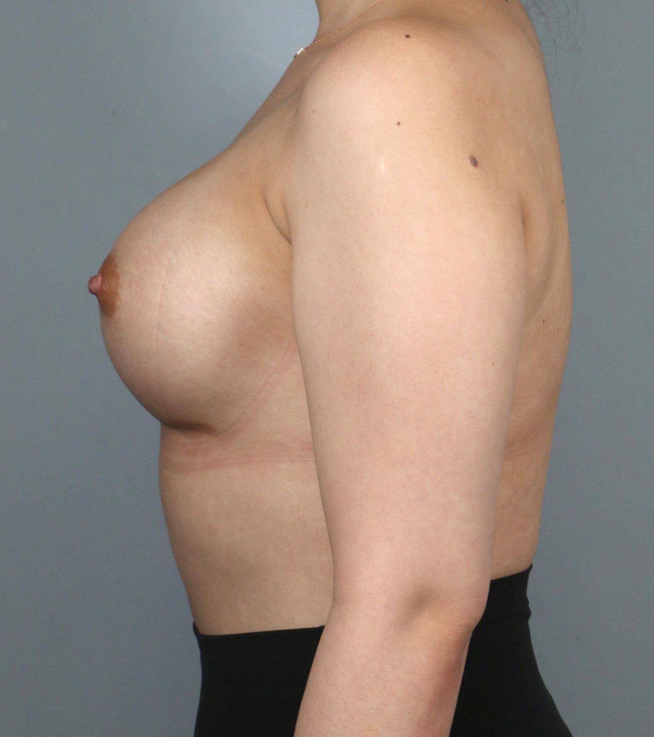 Breast Augmentation Before & After