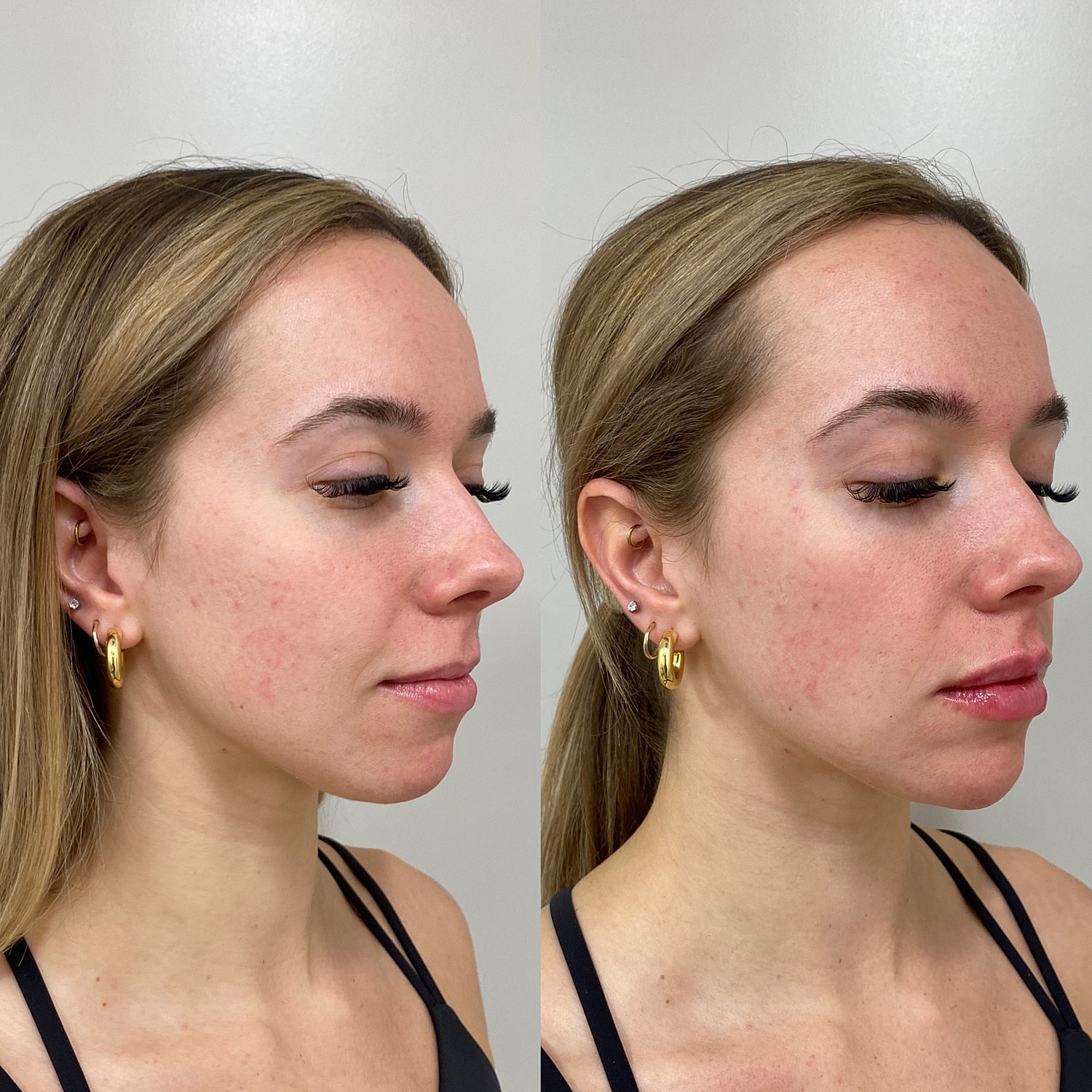 Lip Filler Before & After
