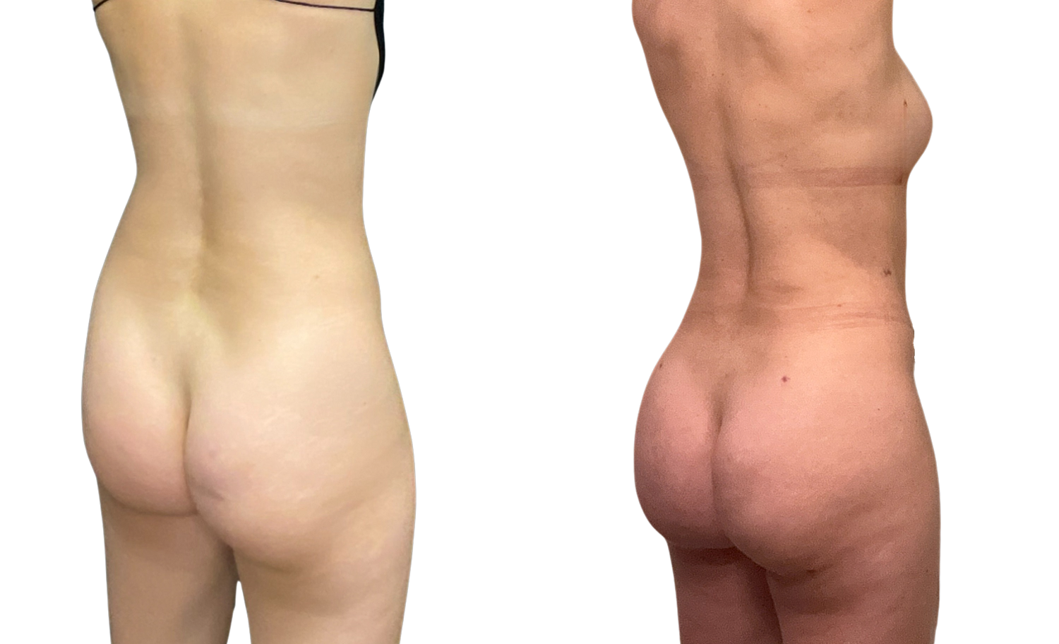 Skinny Brazilian Butt Lift Before & After