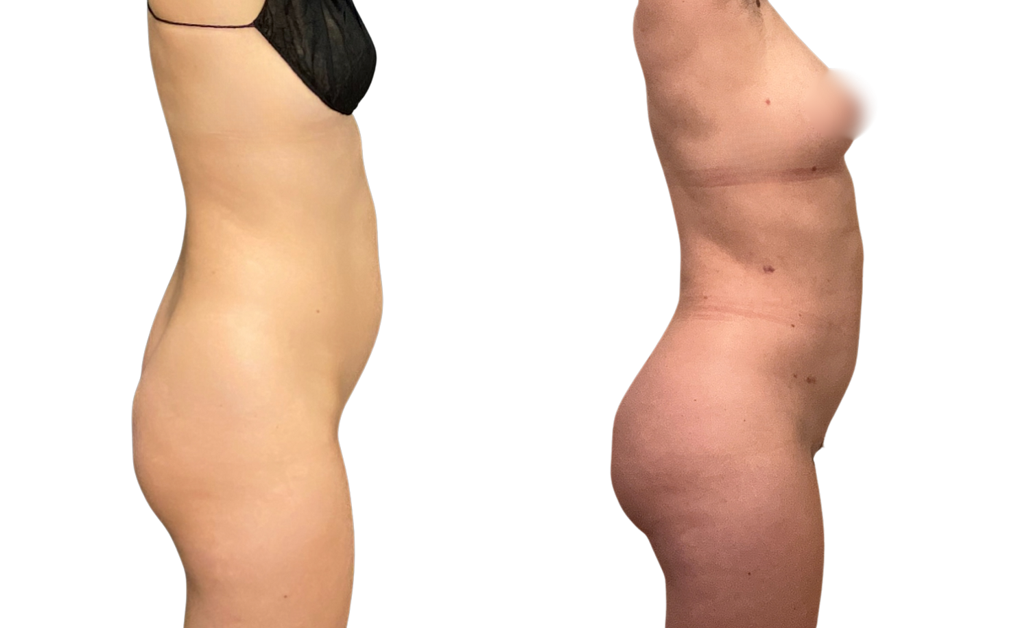 Skinny Brazilian Butt Lift Before & After