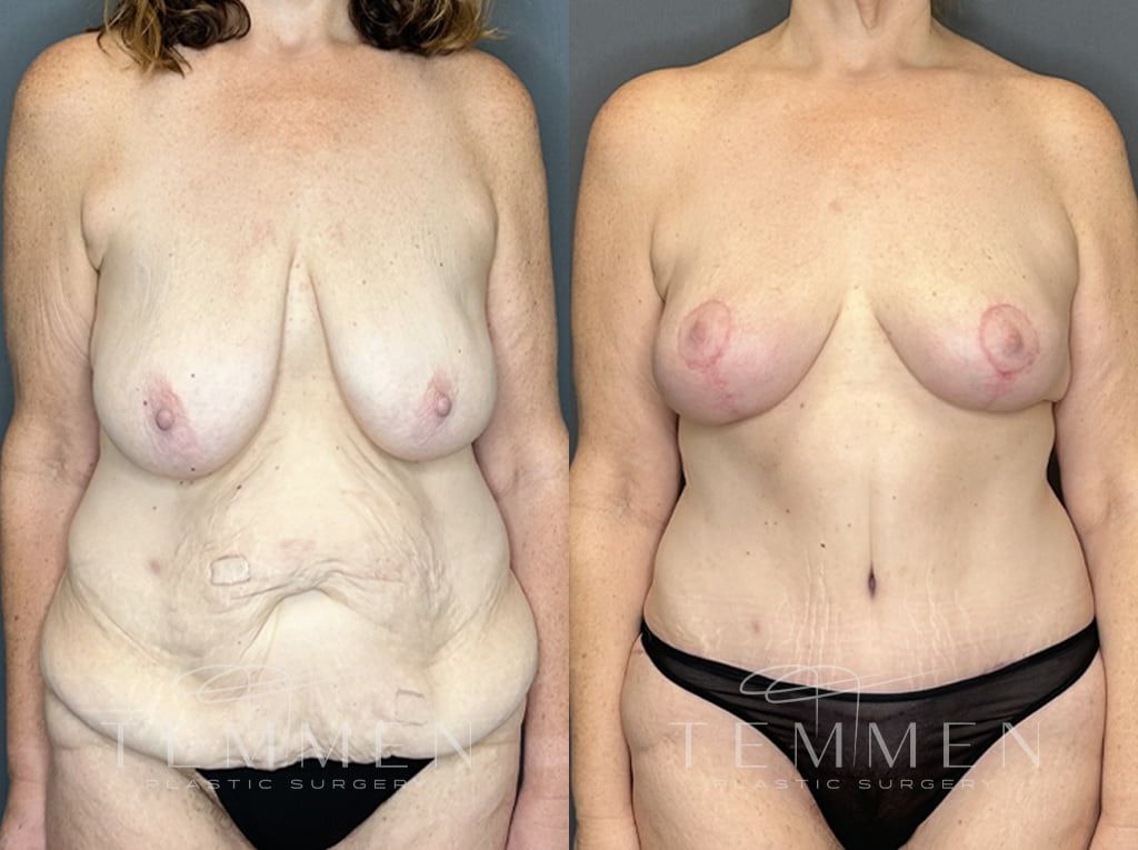 Breast Lift Before & After