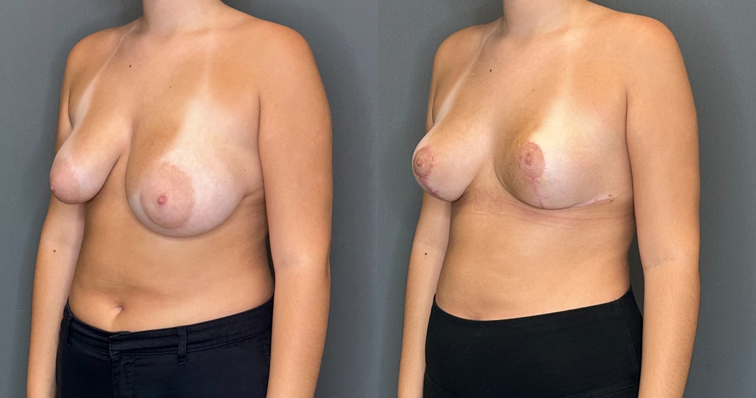Breast Lift Before & After