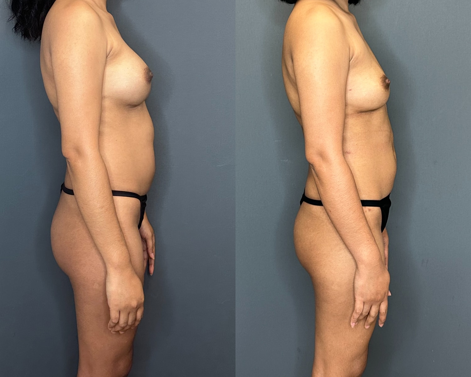Implant Removal With Fat Transfer Before & After
