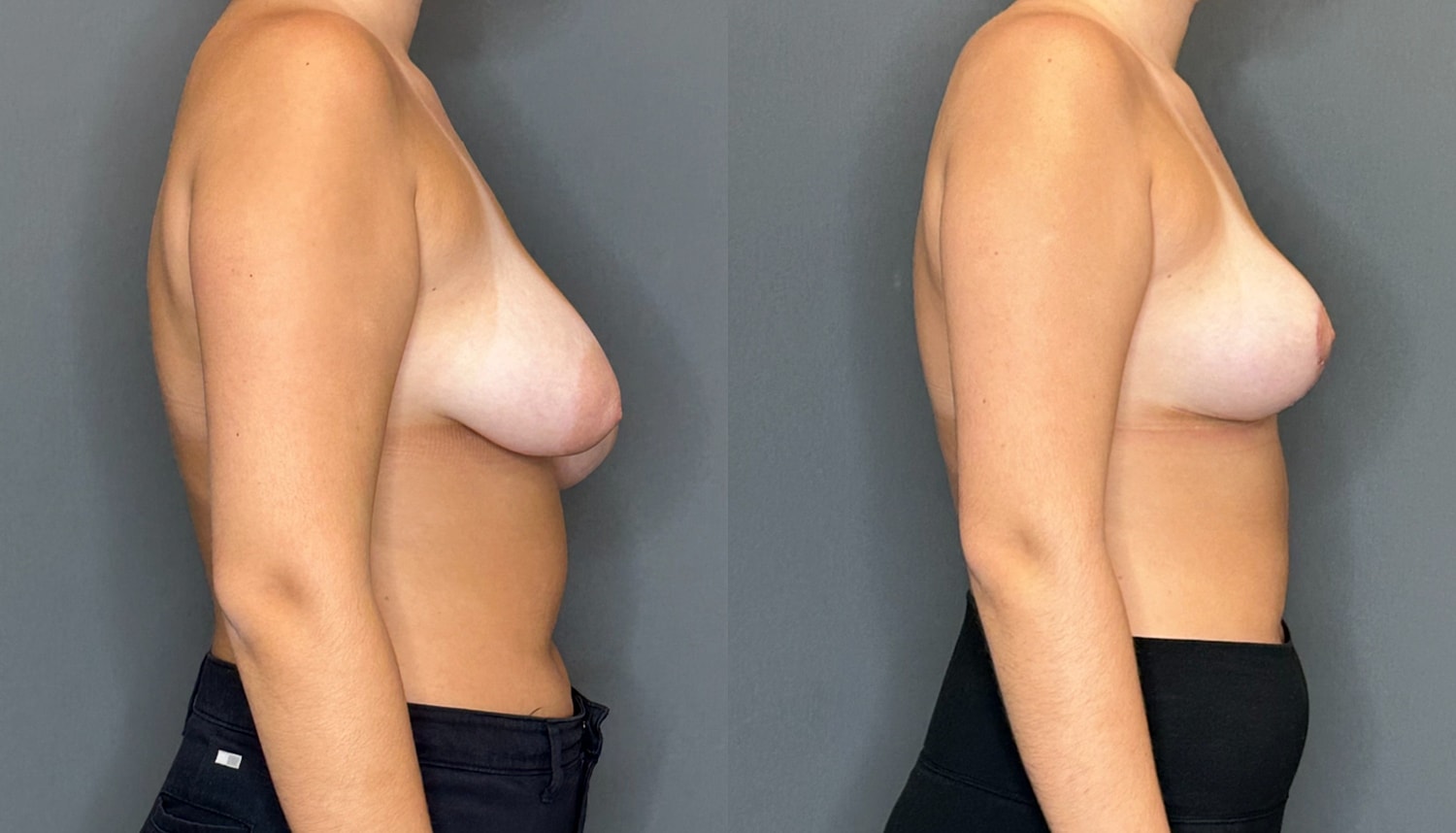Breast Asymmetry Before & After