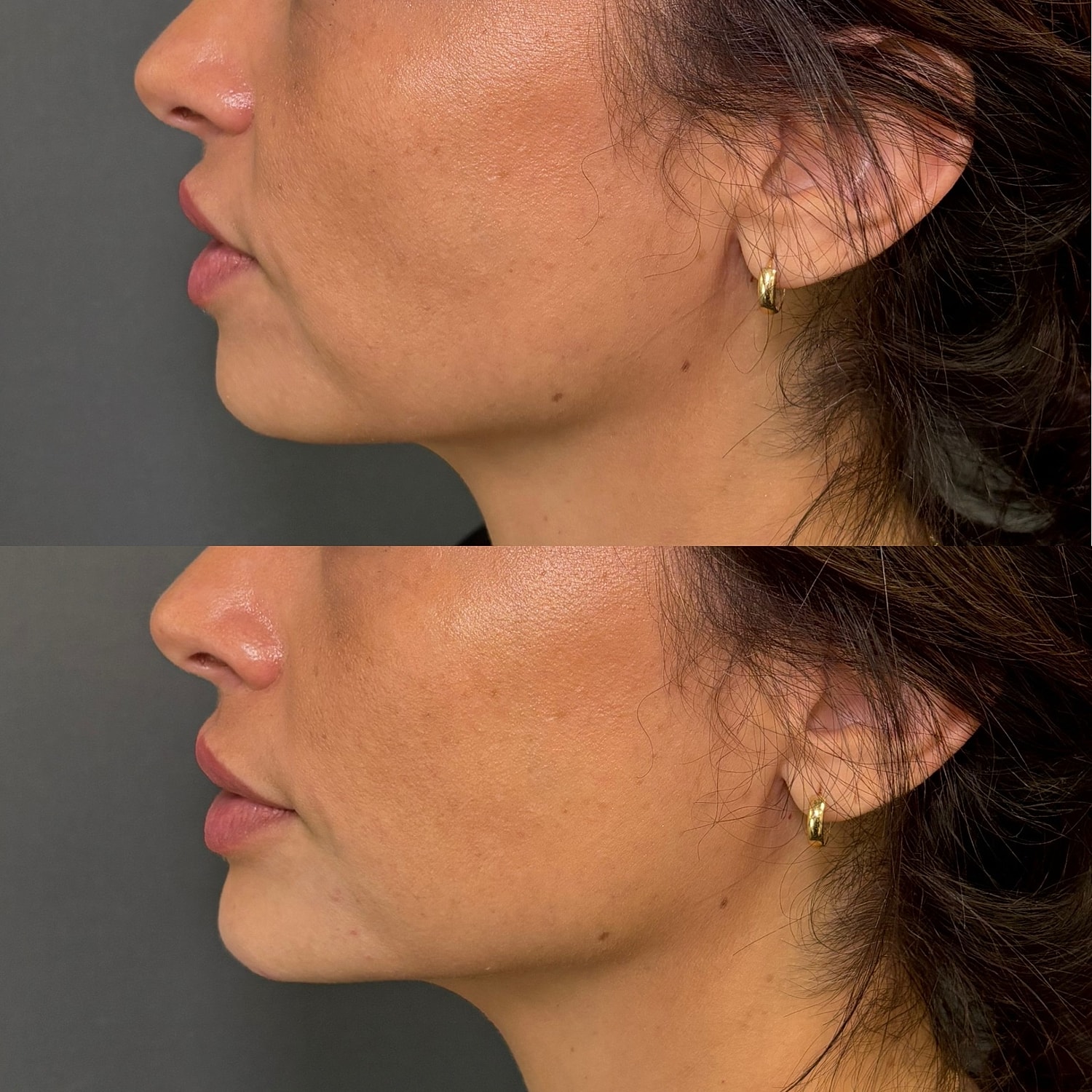 Botox Before & After