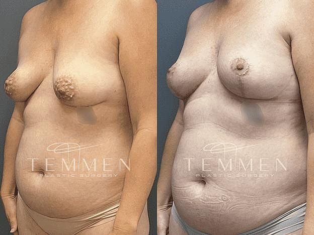 Breast Lift with Fat Transfer Before & After