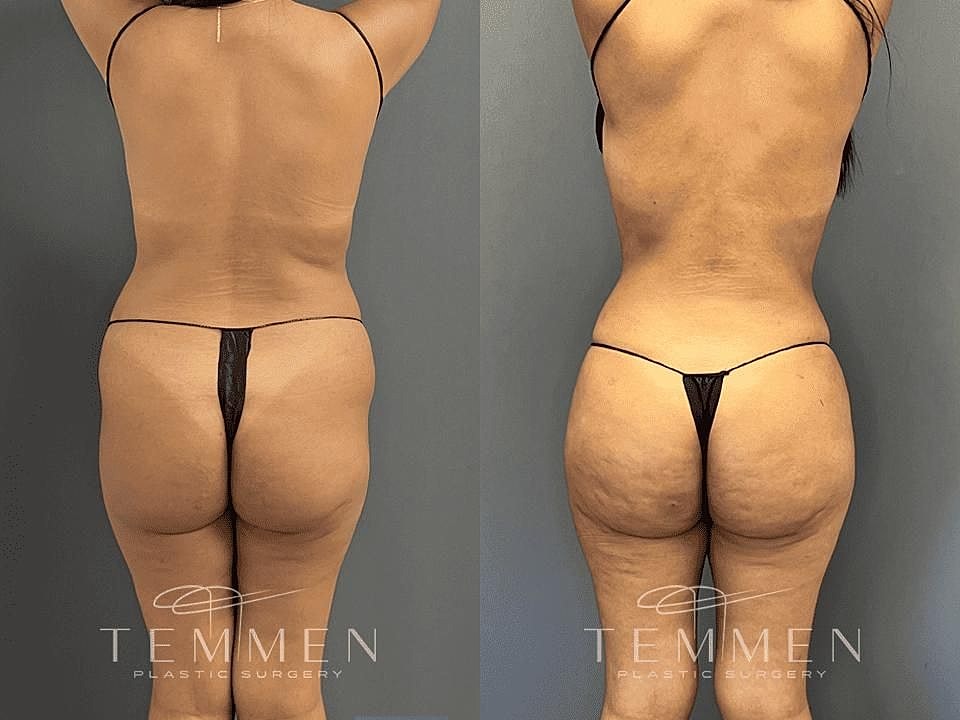 Liposuction Before & After