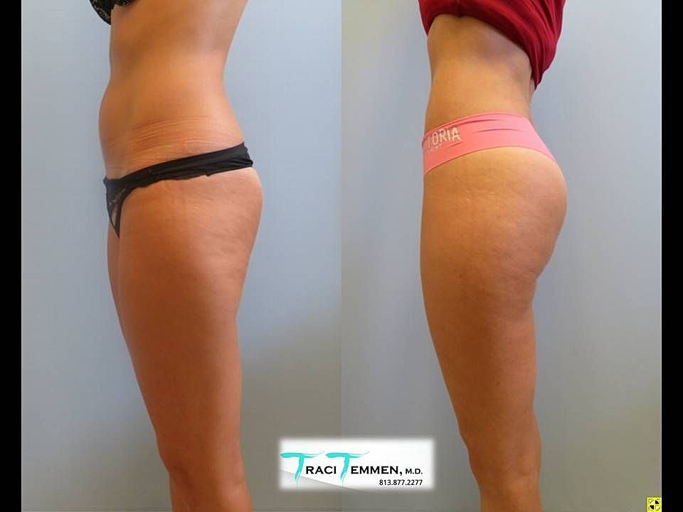 Liposuction Before & After