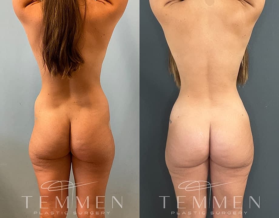 Liposuction Before & After