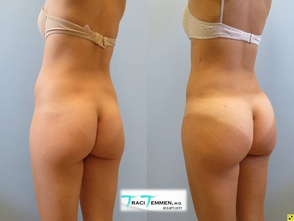 Liposuction Before & After