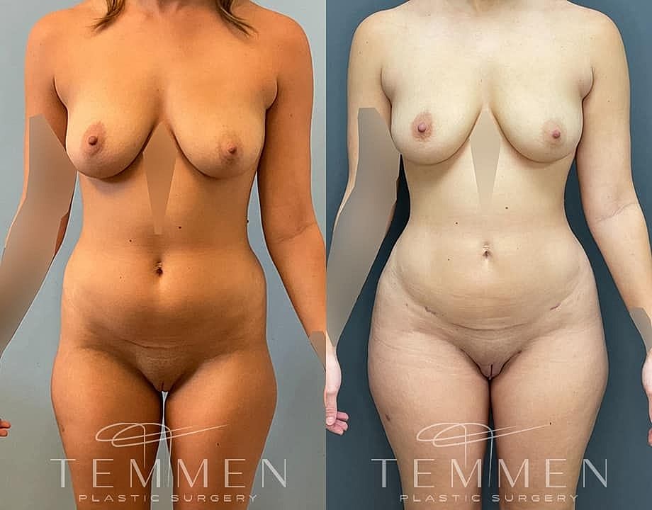 Liposuction Before & After