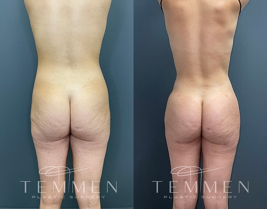 Liposuction Before & After