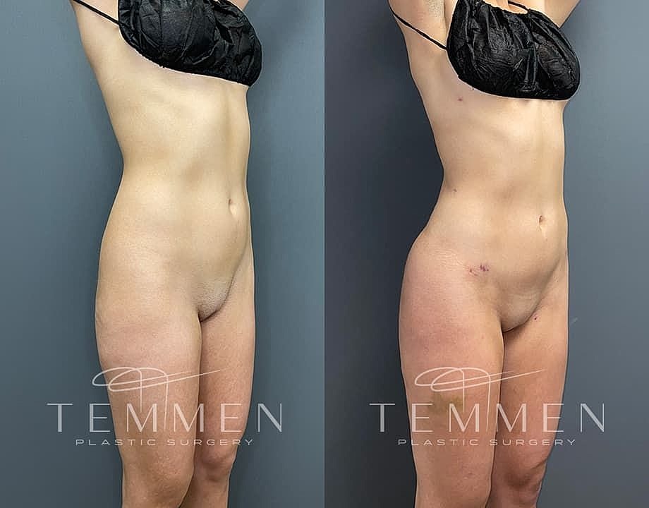 Liposuction Before & After