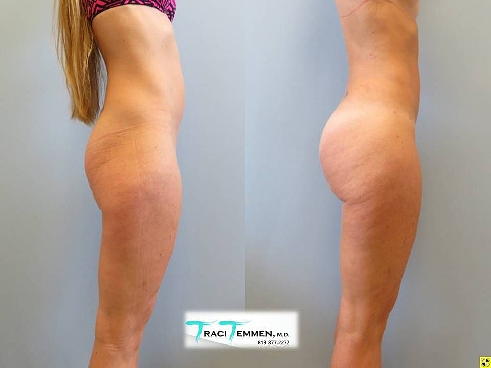 Liposuction Before & After