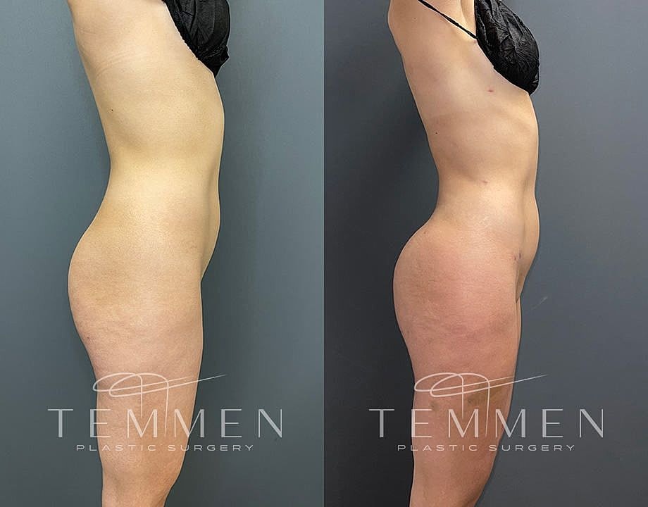 Liposuction Before & After