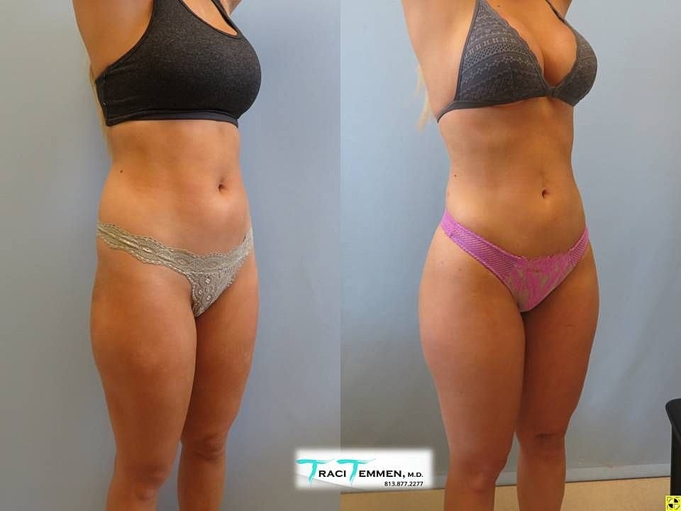 Liposuction Before & After