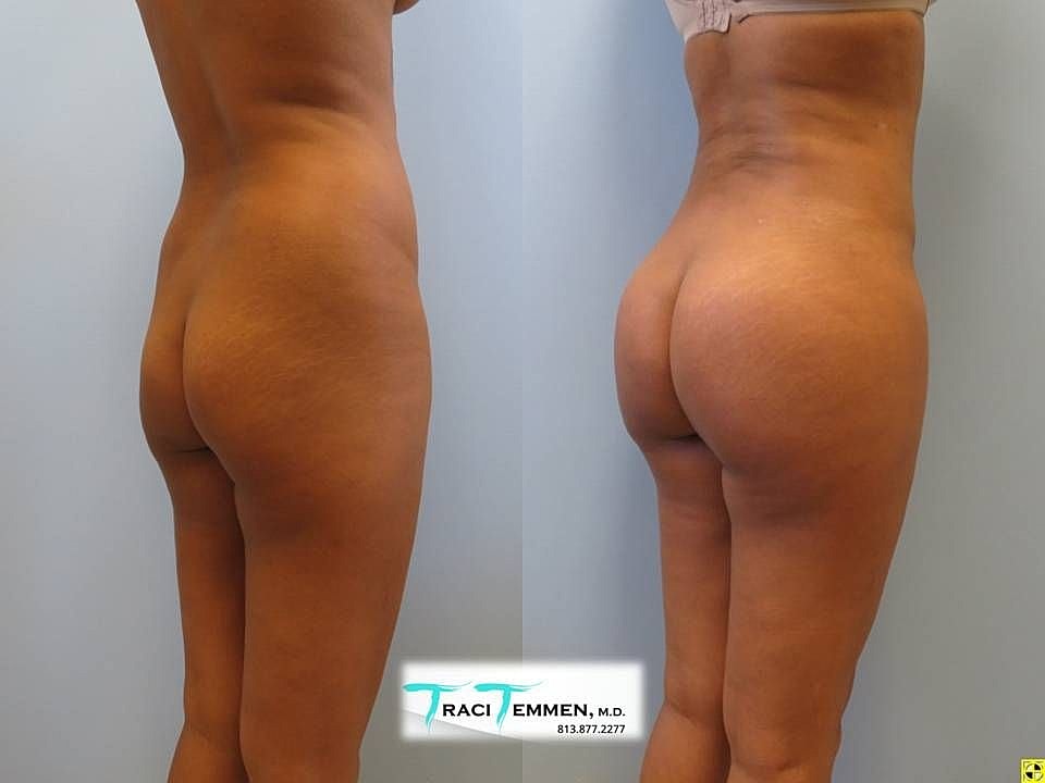 Liposuction Before & After