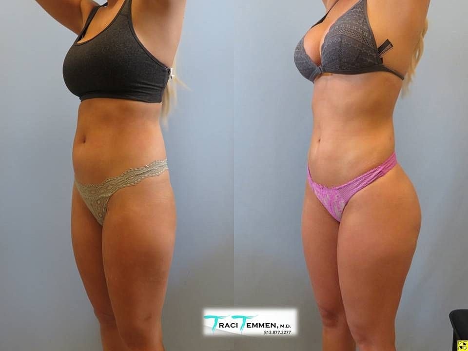 Liposuction Before & After