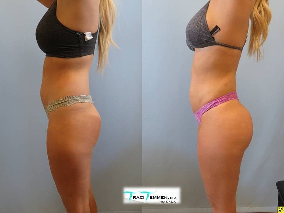 Liposuction Before & After