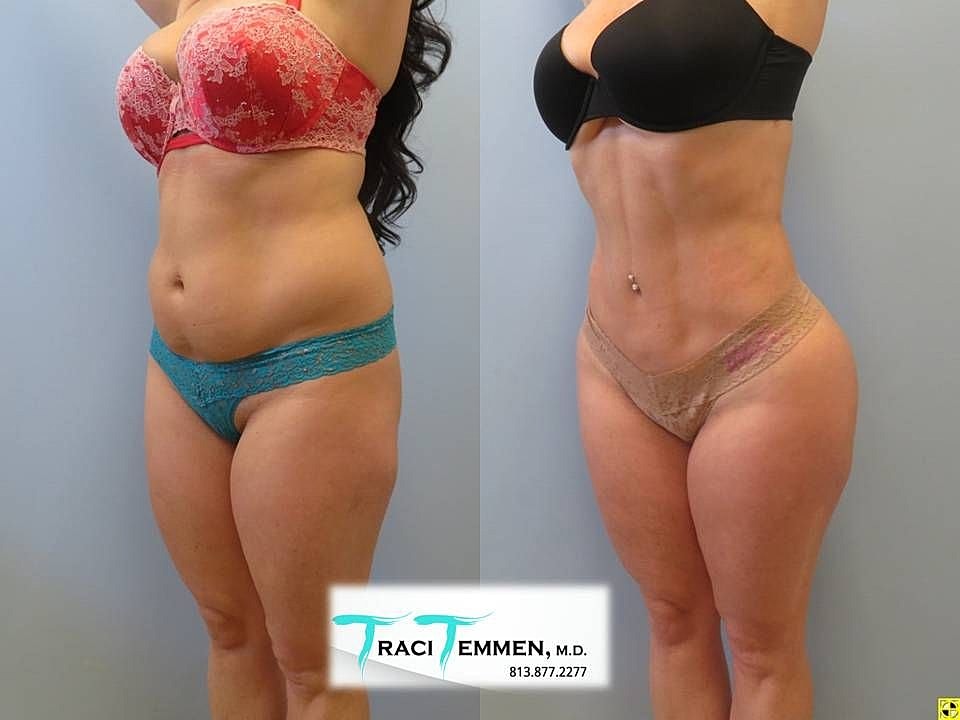 Liposuction Before & After