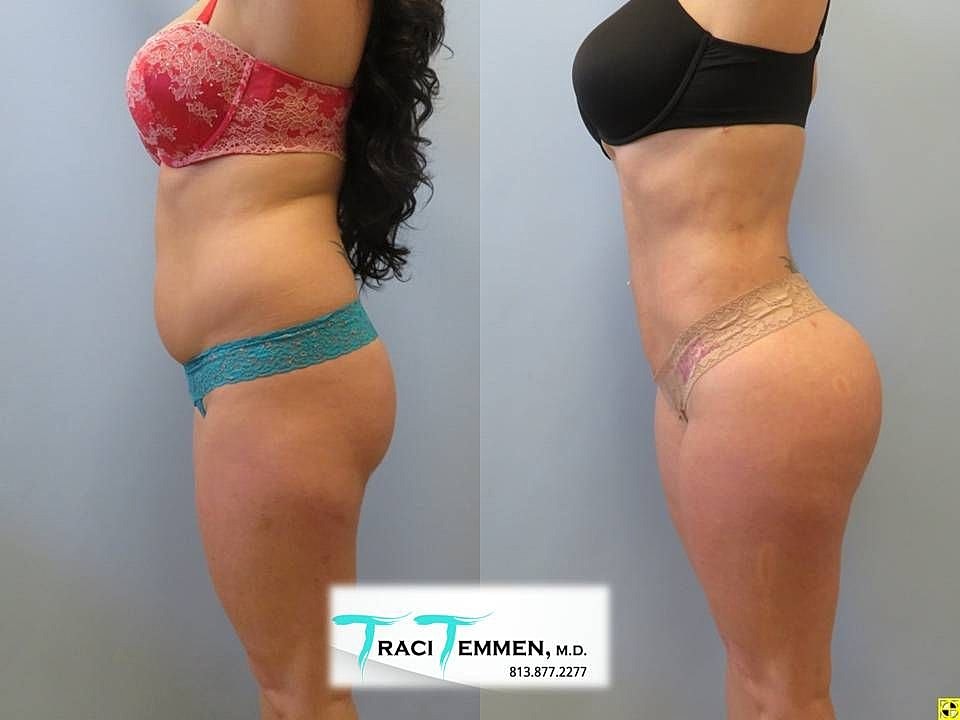 Liposuction Before & After