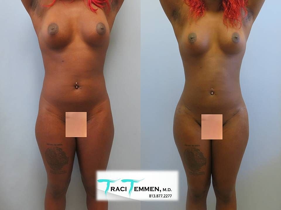 Liposuction Before & After