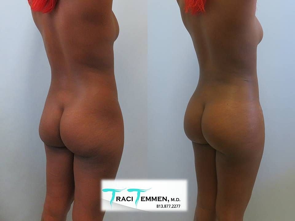 Liposuction Before & After