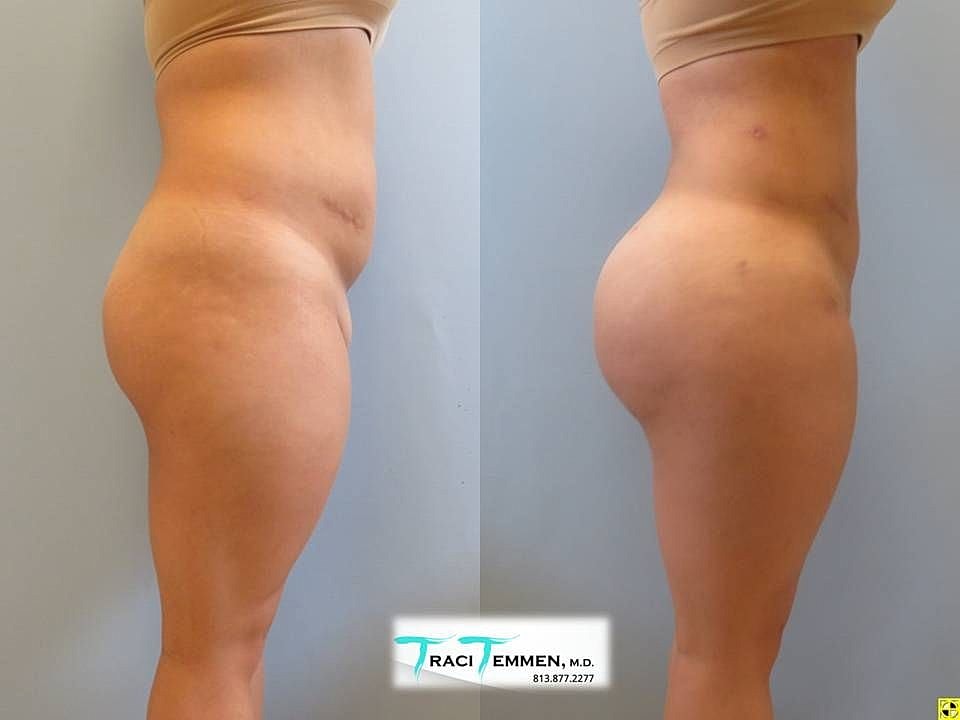 Liposuction Before & After