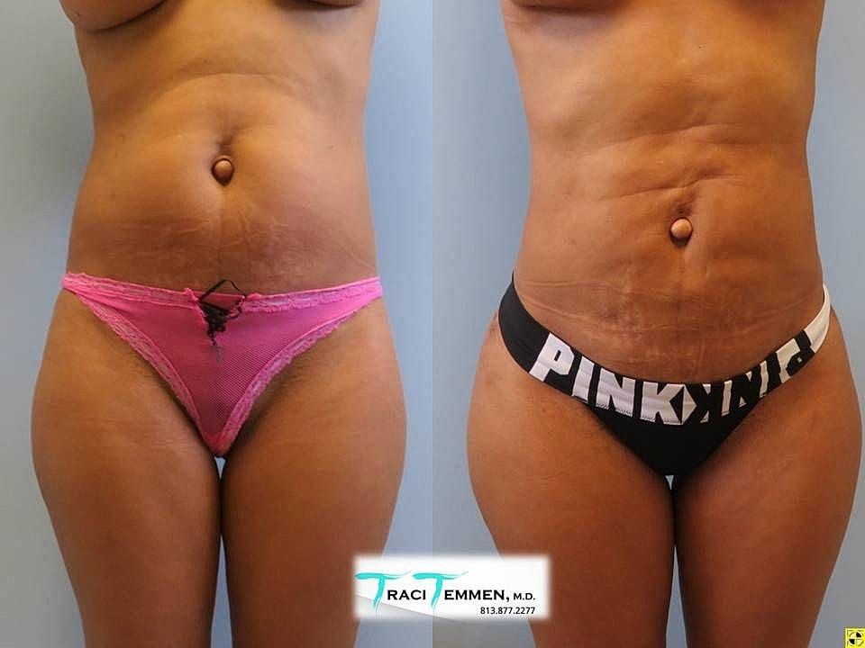 Liposuction Before & After