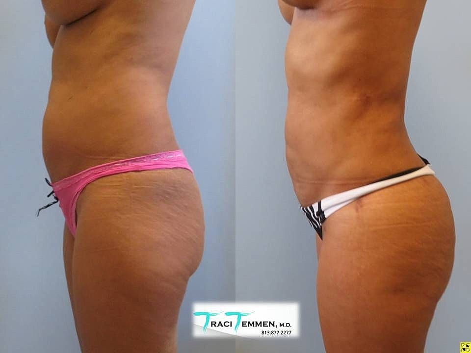 Liposuction Before & After