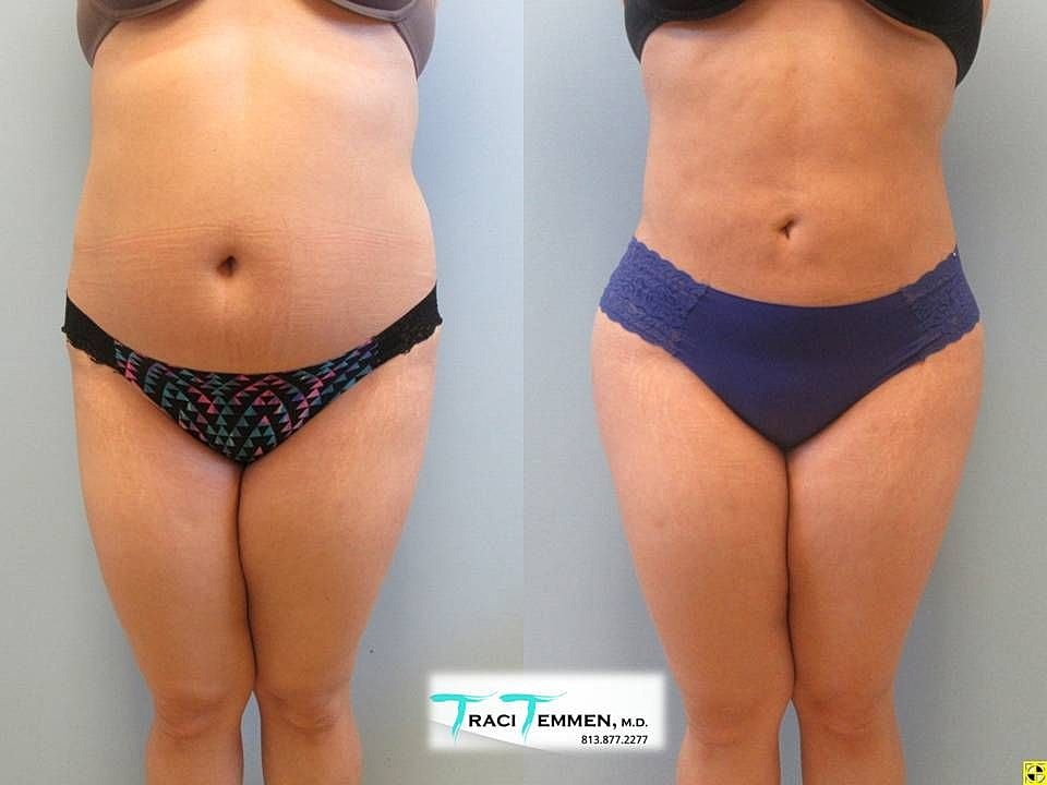 Liposuction Before & After