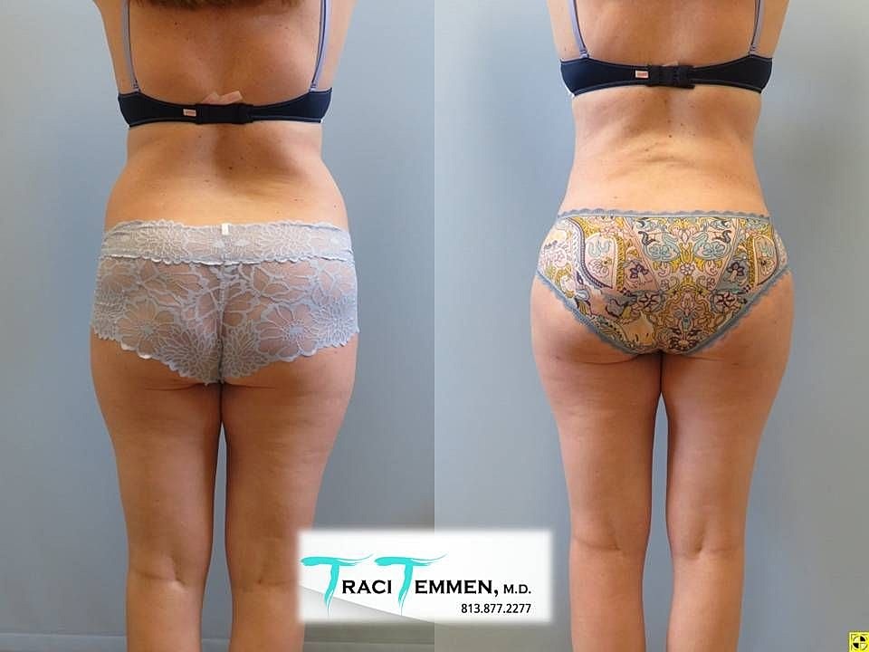 Liposuction Before & After