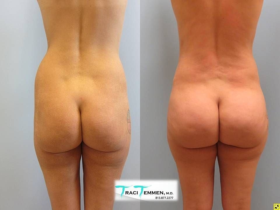 Liposuction Before & After