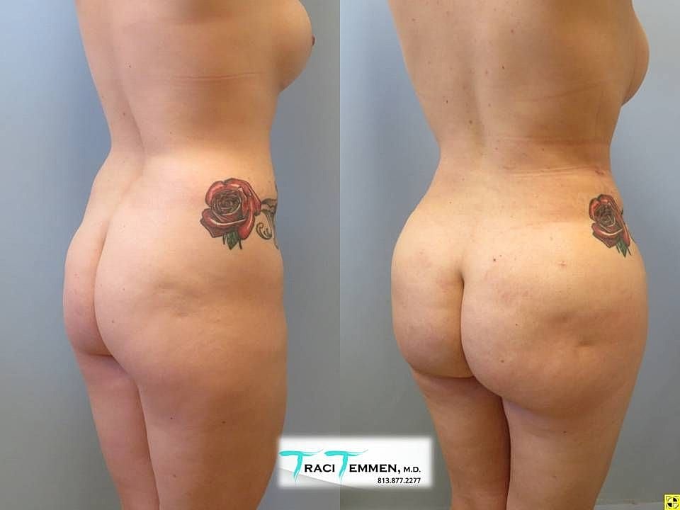 Liposuction Before & After