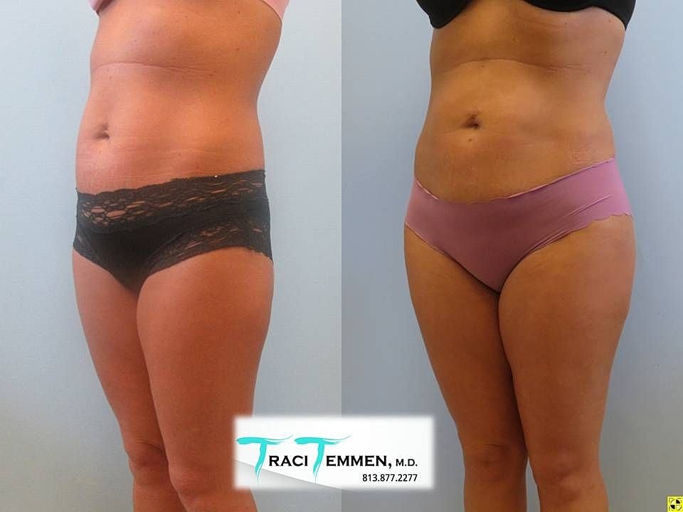 Liposuction Before & After