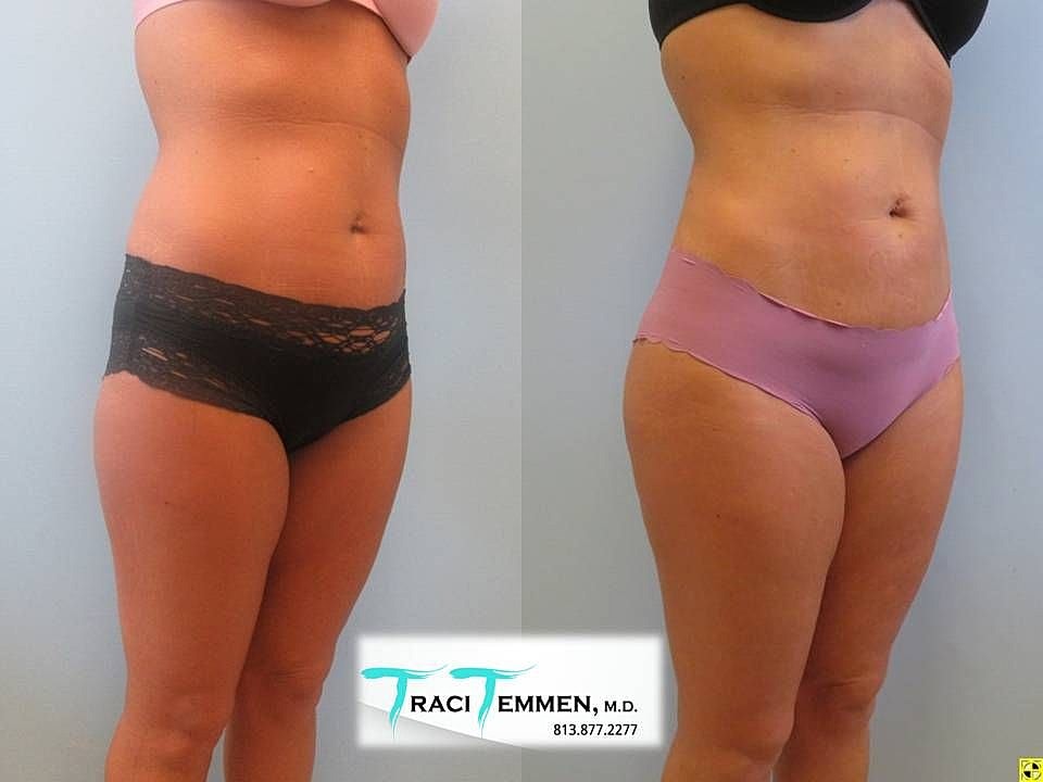 Liposuction Before & After