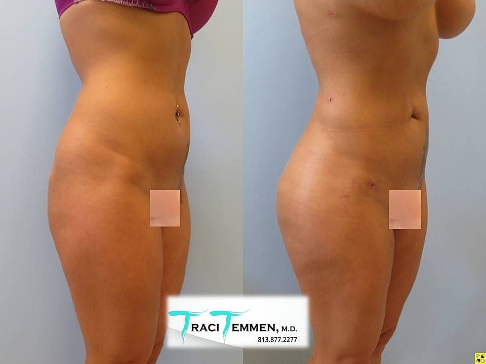 Liposuction Before & After