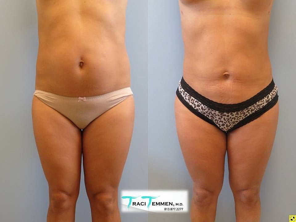 Liposuction Before & After