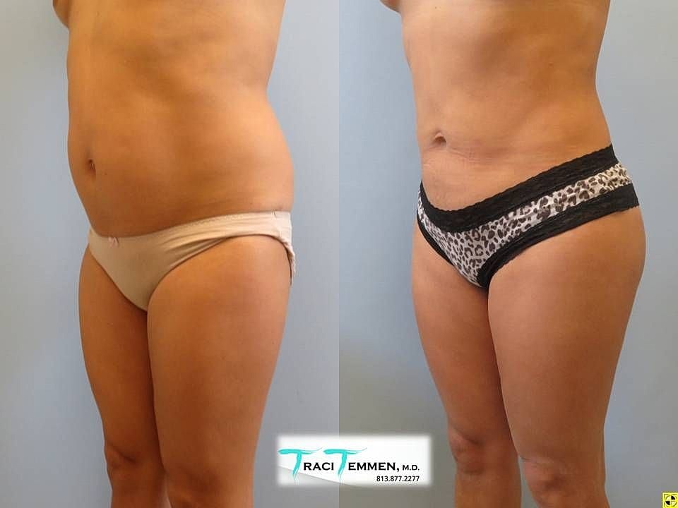 Liposuction Before & After