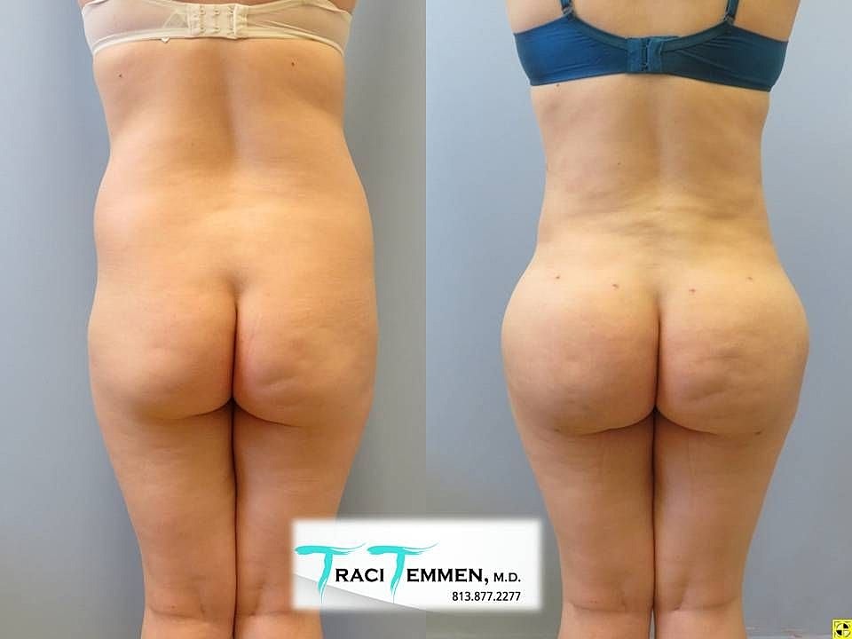 Liposuction Before & After