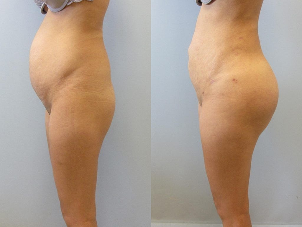 Liposuction Before & After