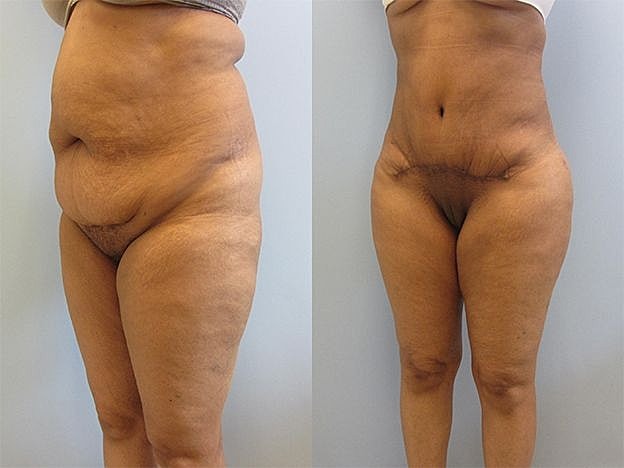 Liposuction Before & After